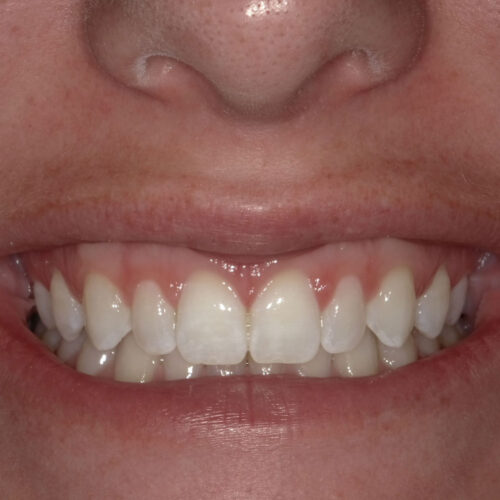 Nu Dentistry  Invisalign FAQs: Braces vs. Invisalign, Costs, & Results!