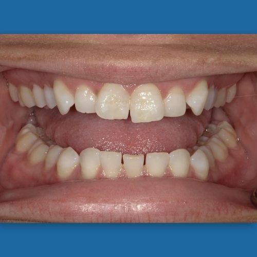 Clear Aligners Before & After: See How They Transform Smiles • Woodhill  Dental Specialties